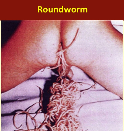 Anal Worms Xxx 2